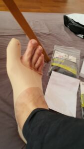 Bunion corrector, photo provided by our customer