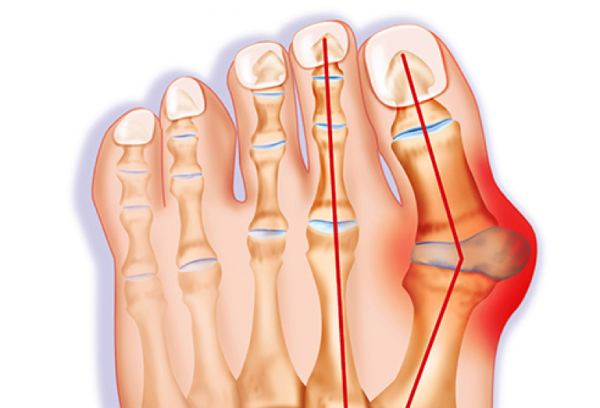 How Do You Know You Have Bunions? - FeetCare