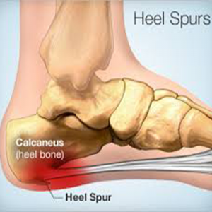 Effective Ways to Get Rid of Painful Heel Spurs Incredible