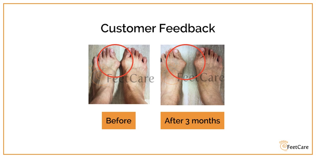 photo testimonial on bunion recovery