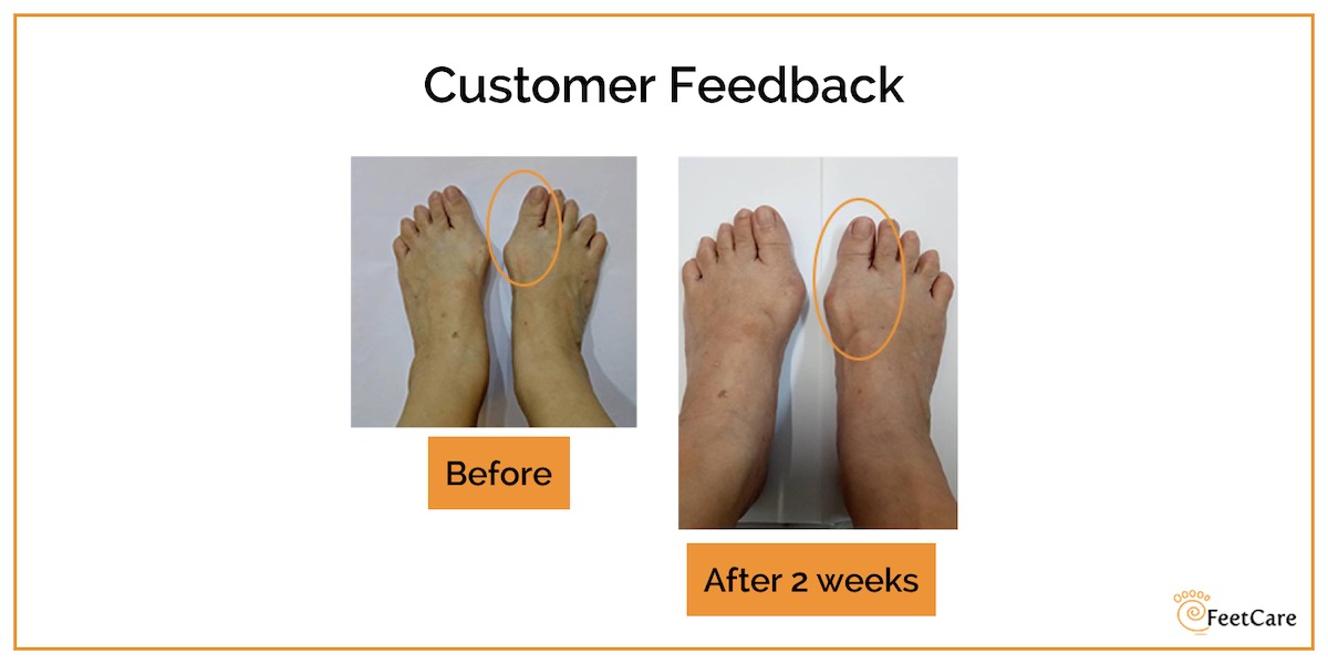 photo testimonial on bunion recovery