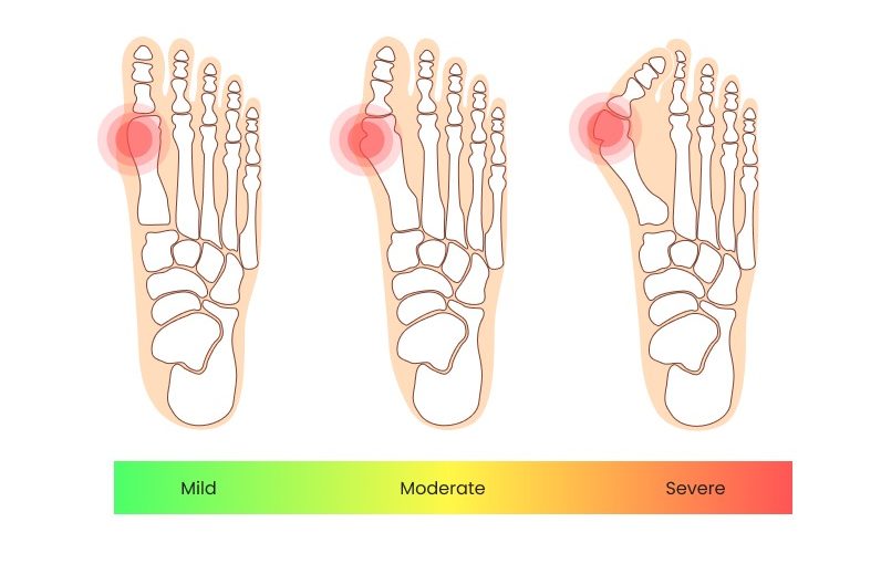 various stages of bunion severity, ranging from mild to severe