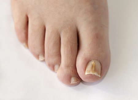 Why Is My Toenail Yellow and Crumbly?: Leonard Greenwald, DPM: Podiatrist