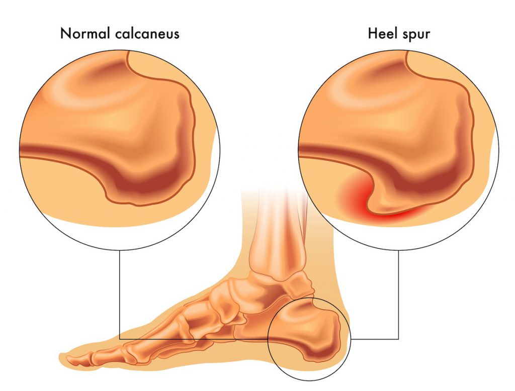 A picture showing plantar fasciitis bone spurs