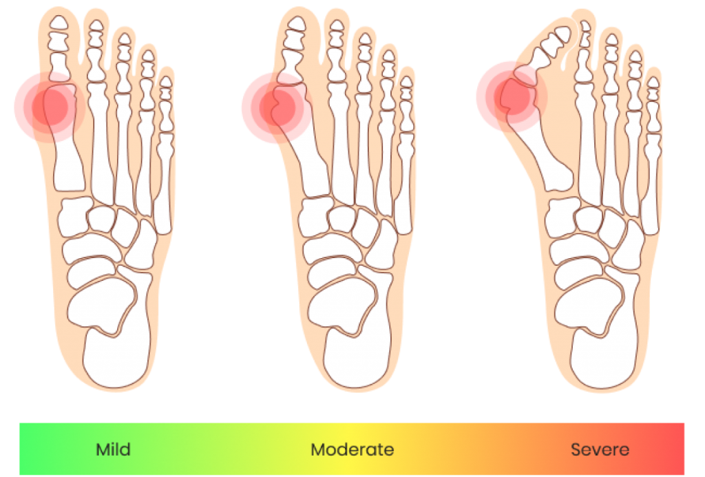 Getting Your Bunions Treated FeetCare