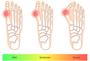 Getting Your Bunions Treated | FeetCare