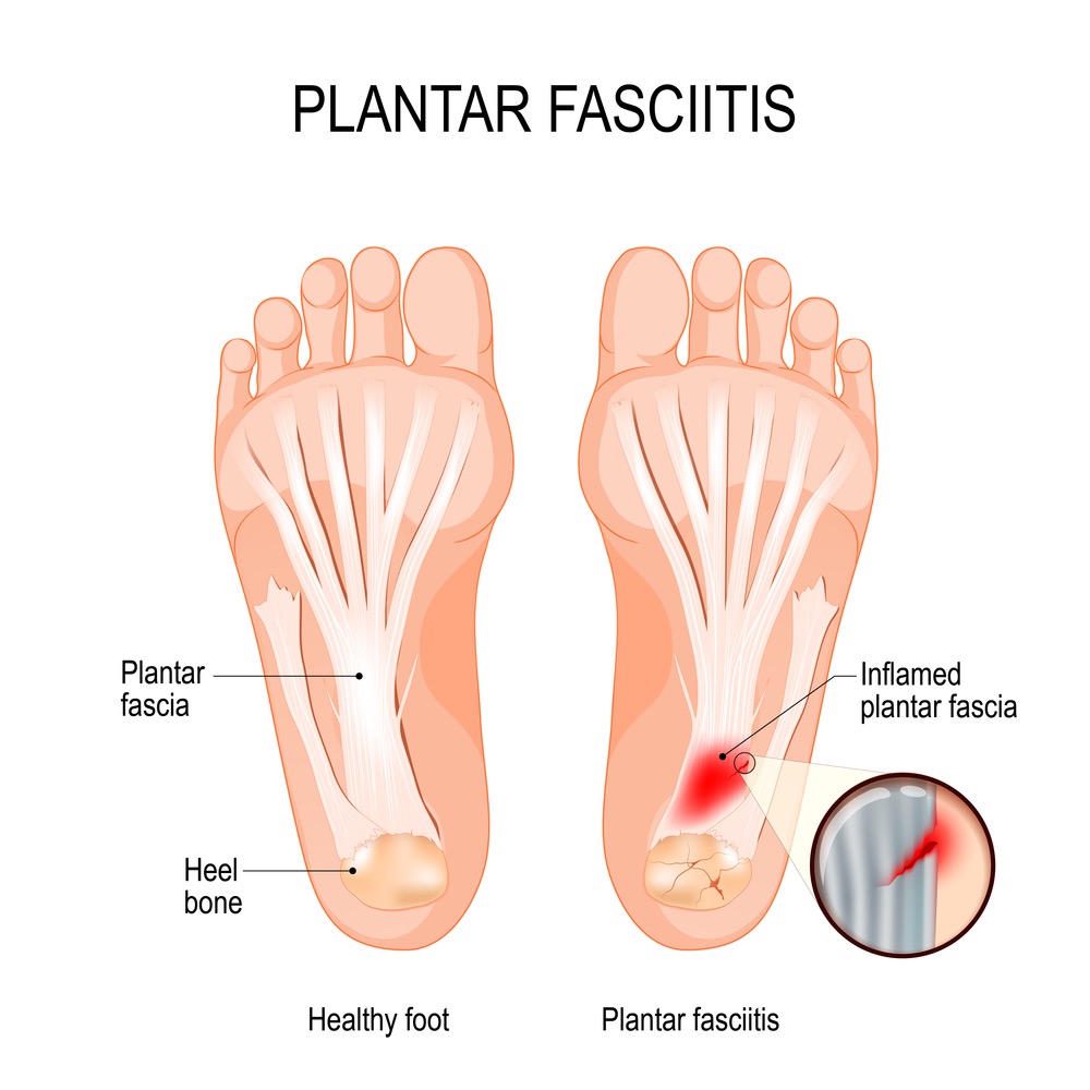 diagram showing how inflammation of the plantar fascia causes plantar fasciitis