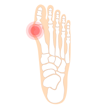 Feet Care specialist for bunions in Singapore