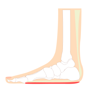 Painful Heel Spur Management in Singapore