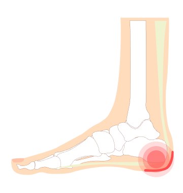 Reason of foot sales heel pain