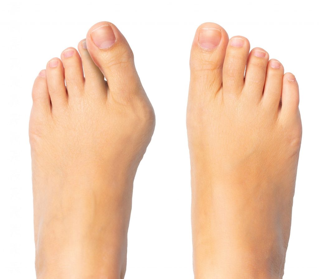 Bunions Beware: Understanding, Preventing, and Treating Pesky Foot  Protrusions - Feet First Clinic