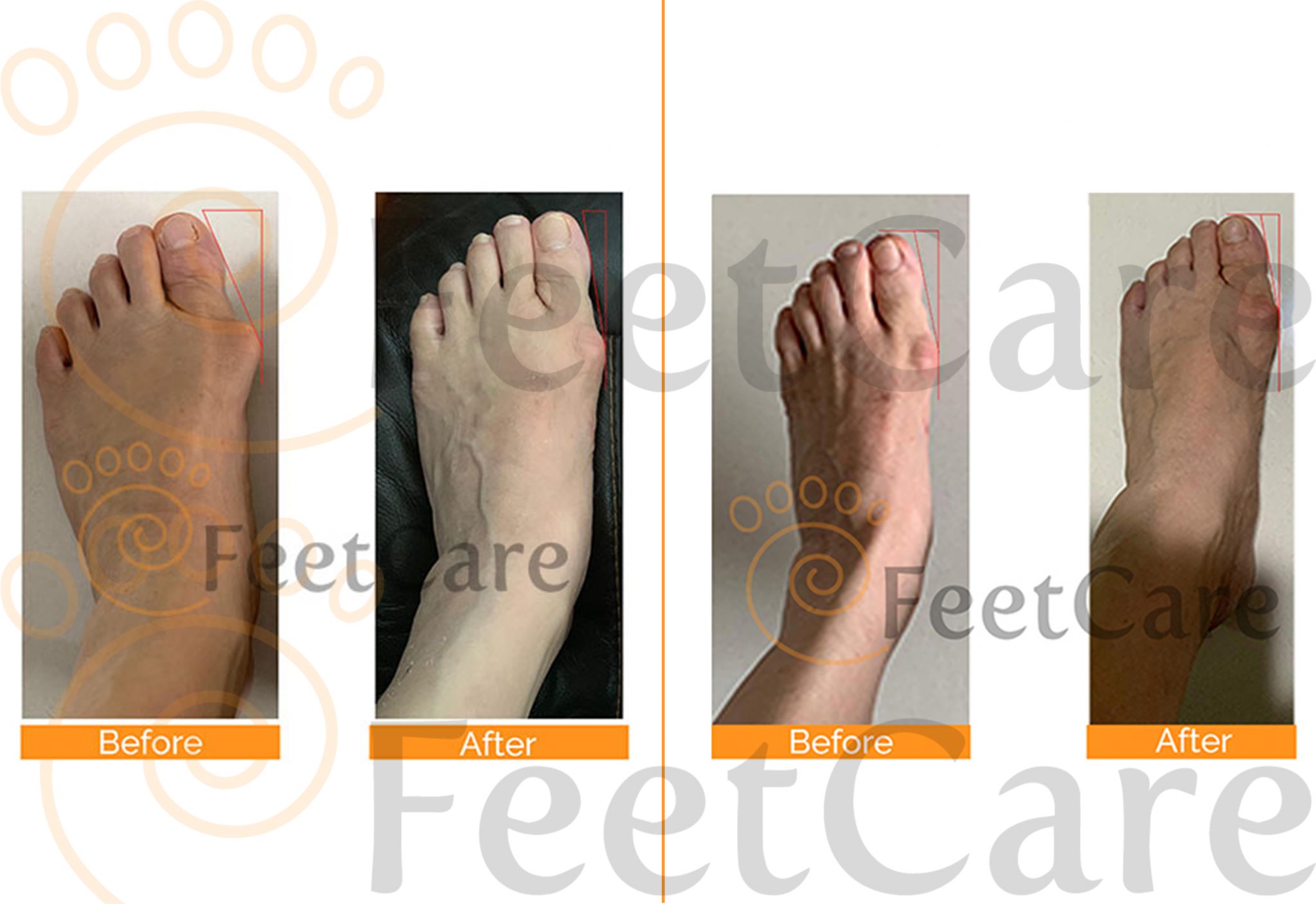 Bunions Corrector Singapore Bunion Cure Assessment FeetCare