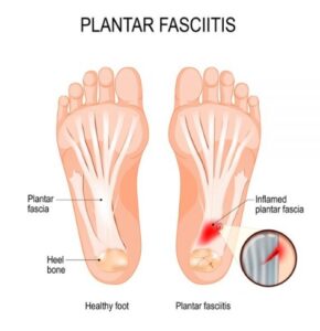 Plantar fasciitis