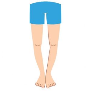 bow leg image